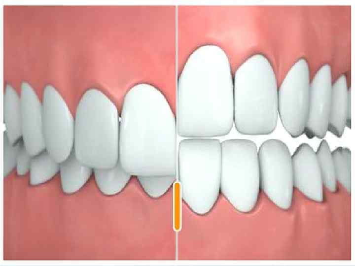  Глубокий прикус – разновидность неправильного прикуса, при котором во время смыкания челюстей отмечается