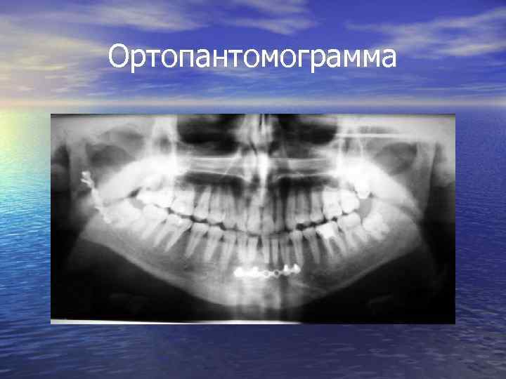 Ортопантомограмма 