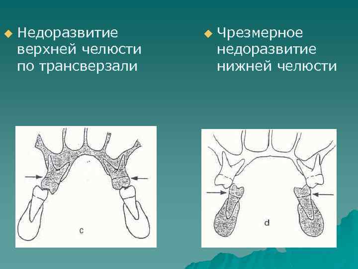 u Недоразвитие верхней челюсти по трансверзали u Чрезмерное недоразвитие нижней челюсти 