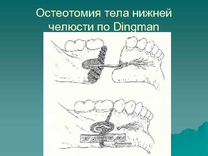 Остеотомия тела нижней челюсти по Dingman 