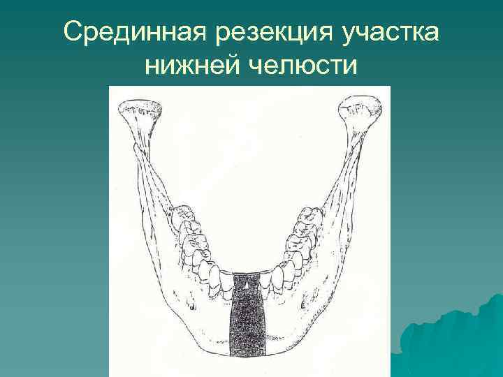 Срединная резекция участка нижней челюсти 