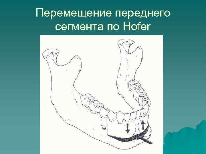 Перемещение переднего сегмента по Hofer 