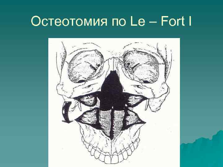Остеотомия по Le – Fort I 