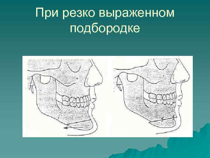 При резко выраженном подбородке 