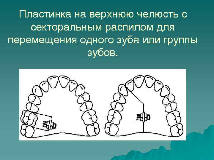 Пластинка на верхнюю челюсть с секторальным распилом для перемещения одного зуба или группы зубов.