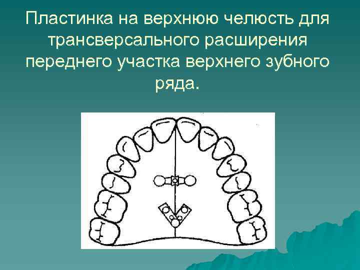 Пластинка на верхнюю челюсть для трансверсального расширения переднего участка верхнего зубного ряда. 