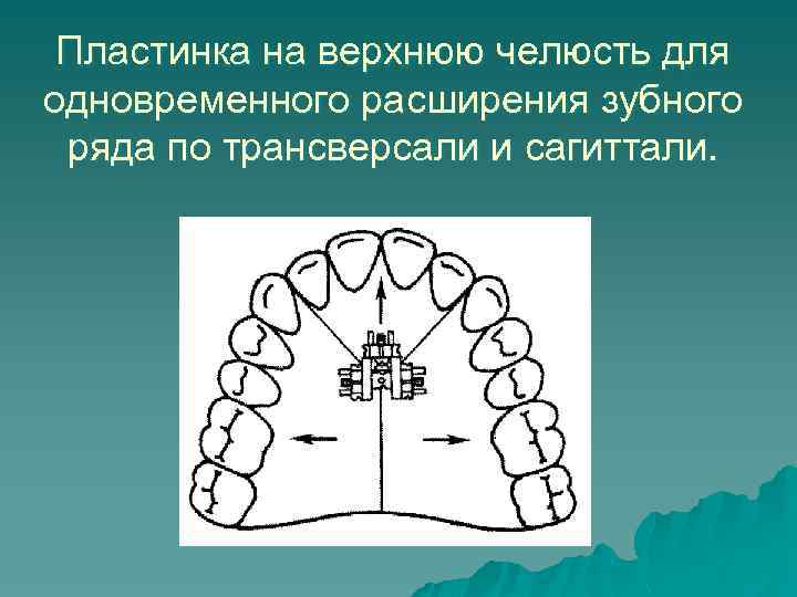 Пластинка на верхнюю челюсть для одновременного расширения зубного ряда по трансверсали и сагиттали. 