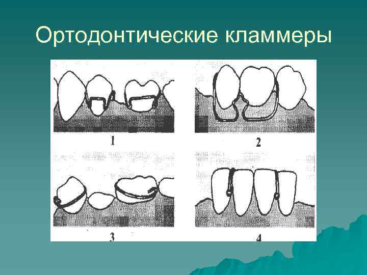 Ортодонтические кламмеры 