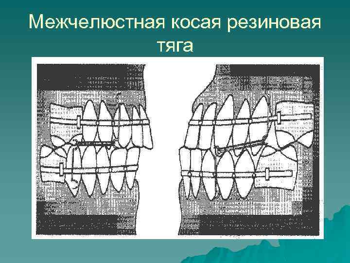 Межчелюстная косая резиновая тяга 