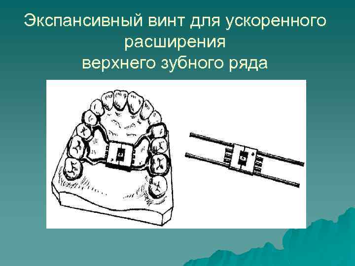 Экспансивный винт для ускоренного расширения верхнего зубного ряда 