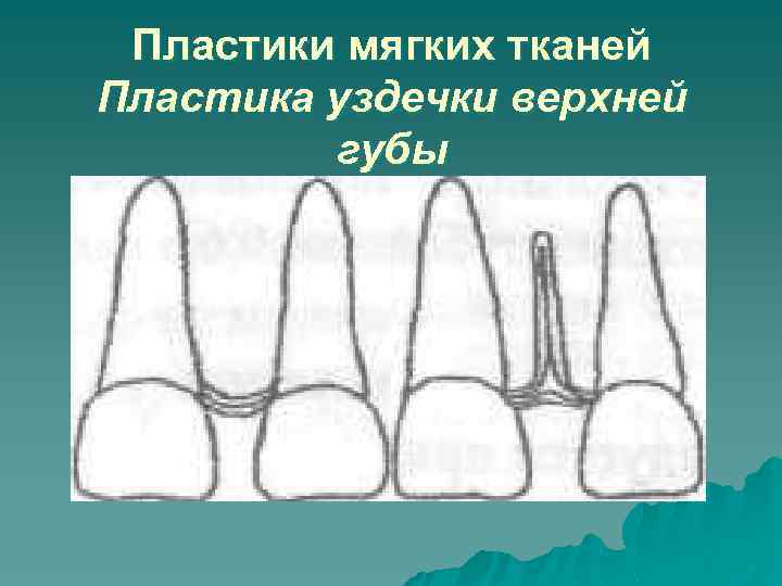 Пластики мягких тканей Пластика уздечки верхней губы 