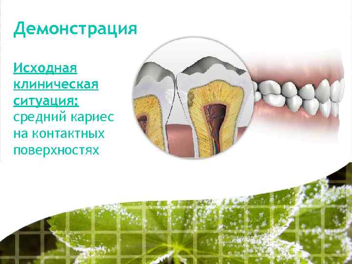 Демонстрация Исходная клиническая ситуация: средний кариес на контактных поверхностях 