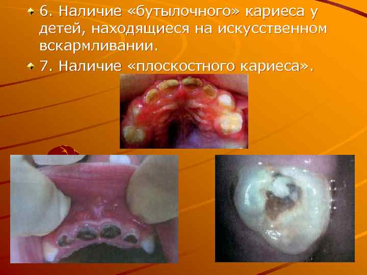 6. Наличие «бутылочного» кариеса у детей, находящиеся на искусственном вскармливании. 7. Наличие «плоскостного кариеса»