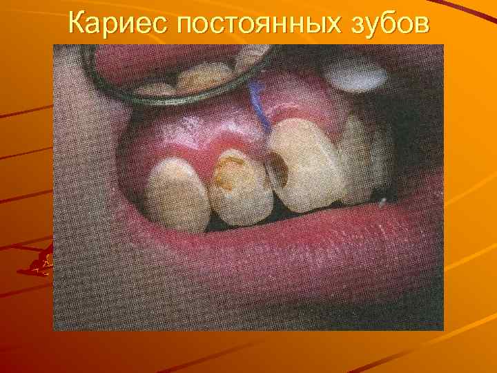 Кариес постоянных зубов 