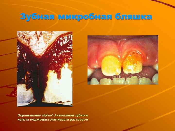 Зубная микробная бляшка Окрашивание alpha-1, 4 -глюканов зубного налета иод-иодистокалиевым раствором 