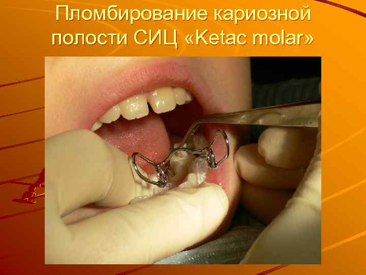 Пломбирование кариозной полости СИЦ «Ketac molar» 