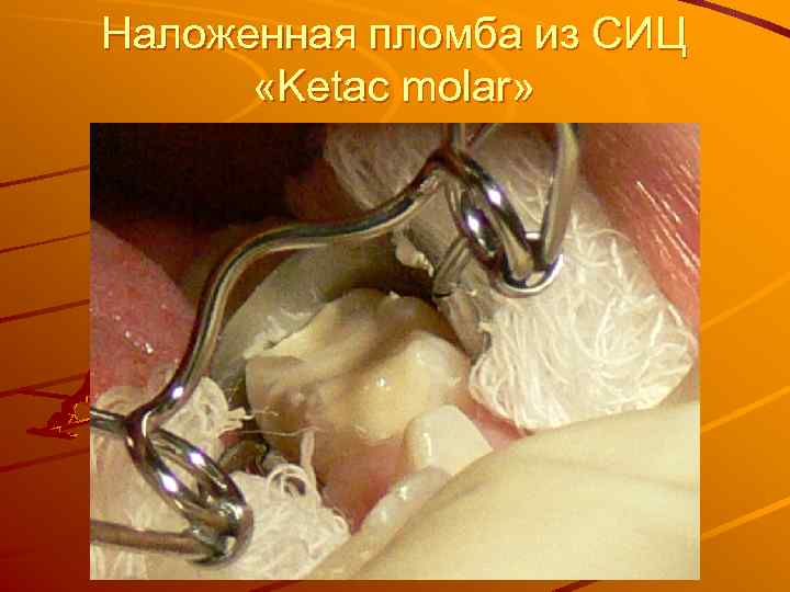 Наложенная пломба из СИЦ «Ketac molar» 