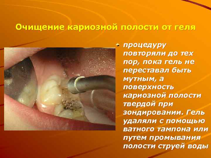 Очищение кариозной полости от геля процедуру повторяли до тех пор, пока гель не переставал