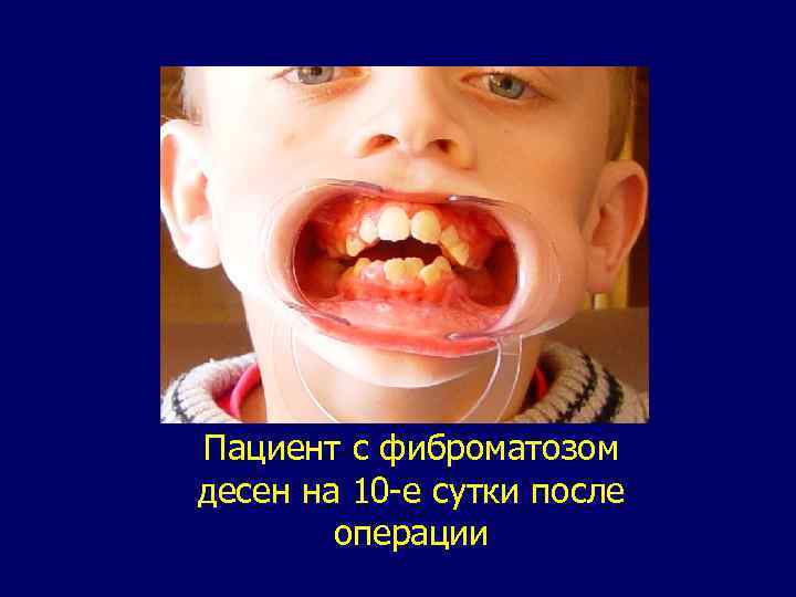 Пациент c фиброматозом десен на 10 -е сутки после операции 