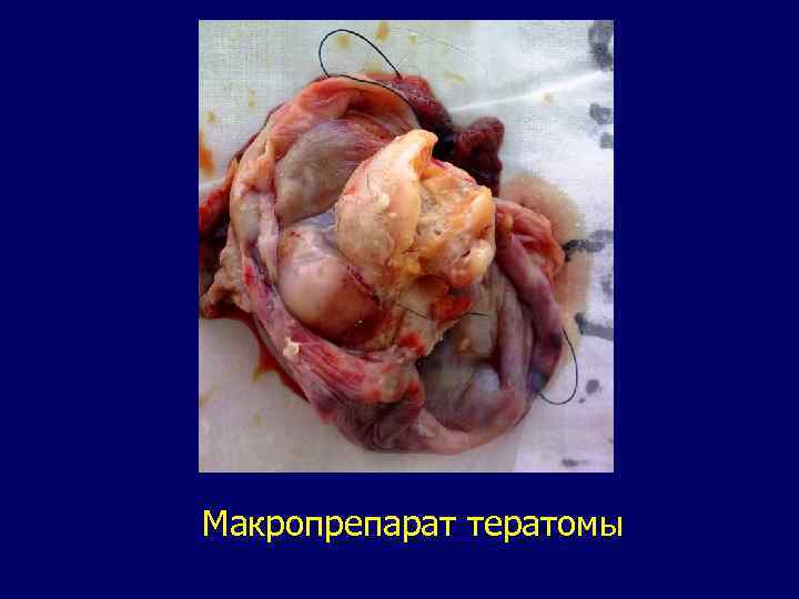 Макропрепарат тератомы 