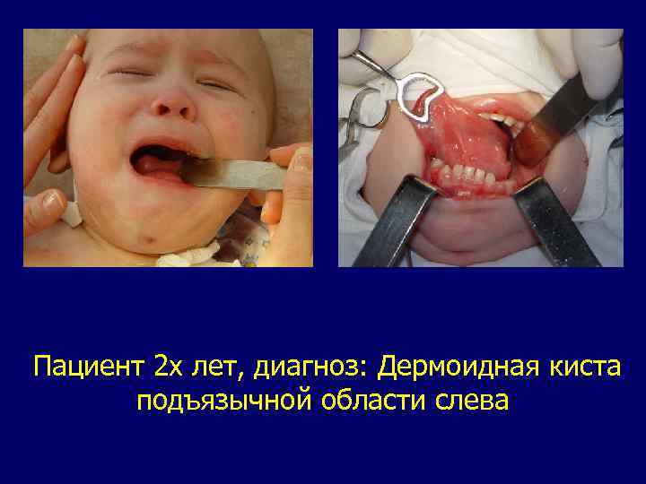 Пациент 2 х лет, диагноз: Дермоидная киста подъязычной области слева 