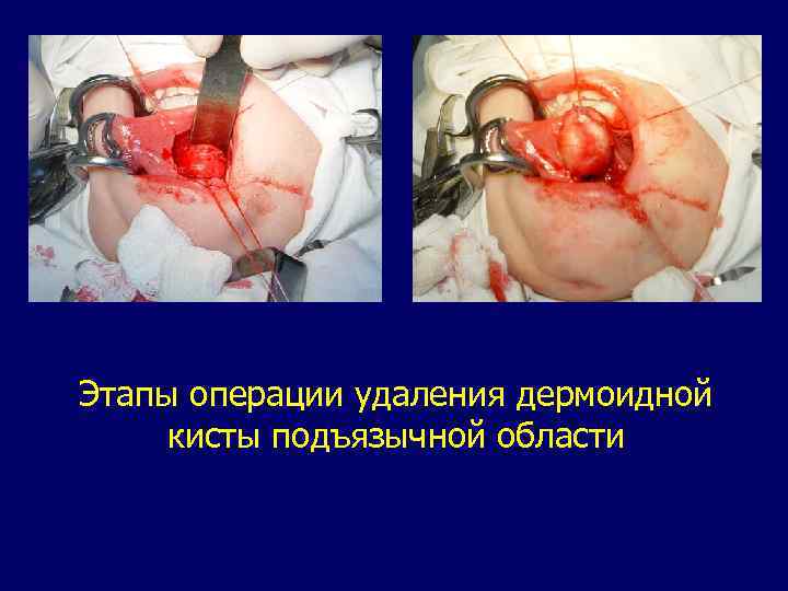 Этапы операции удаления дермоидной кисты подъязычной области 