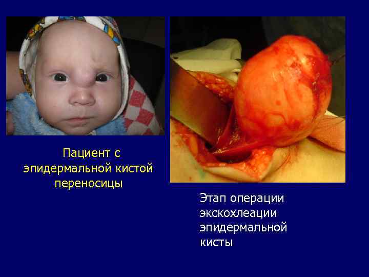 Пациент с эпидермальной кистой переносицы Этап операции экскохлеации эпидермальной кисты 