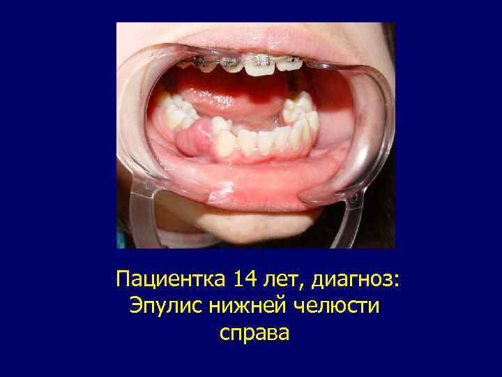 Пациентка 14 лет, диагноз: Эпулис нижней челюсти справа 