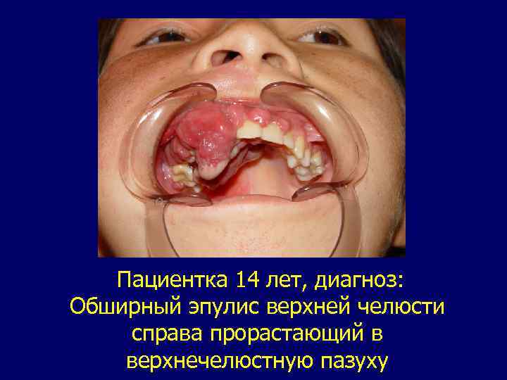 Пациентка 14 лет, диагноз: Обширный эпулис верхней челюсти справа прорастающий в верхнечелюстную пазуху 