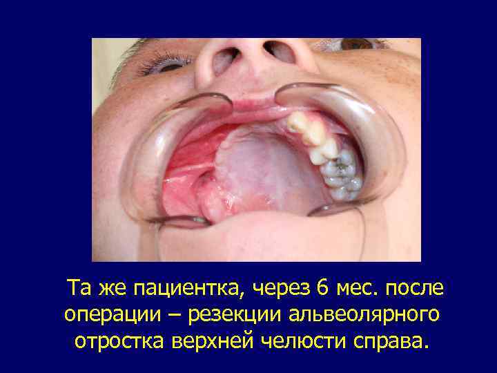 Та же пациентка, через 6 мес. после операции – резекции альвеолярного отростка верхней челюсти