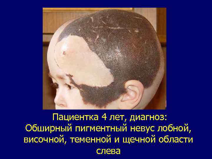 Пациентка 4 лет, диагноз: Обширный пигментный невус лобной, височной, теменной и щечной области слева