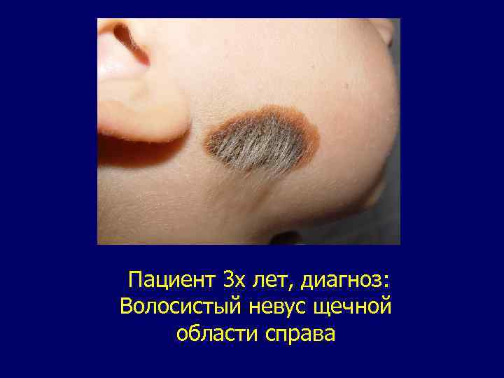 Пациент 3 х лет, диагноз: Волосистый невус щечной области справа 