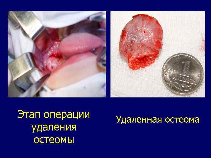 Этап операции удаления остеомы Удаленная остеома 