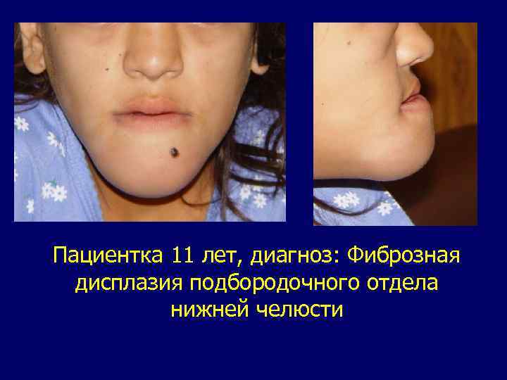 Пациентка 11 лет, диагноз: Фиброзная дисплазия подбородочного отдела нижней челюсти 