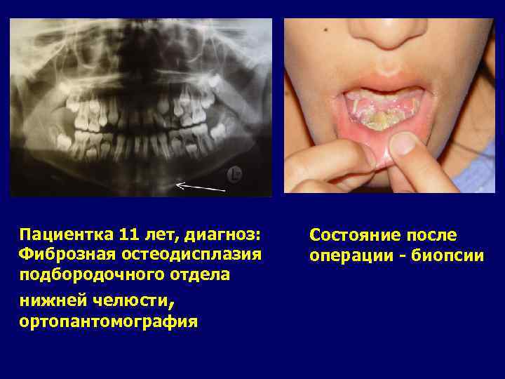 Пациентка 11 лет, диагноз: Фиброзная остеодисплазия подбородочного отдела нижней челюсти, ортопантомография Состояние после операции