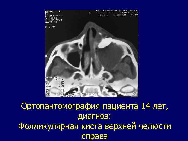 Ортопантомография пациента 14 лет, диагноз: Фолликулярная киста верхней челюсти справа 