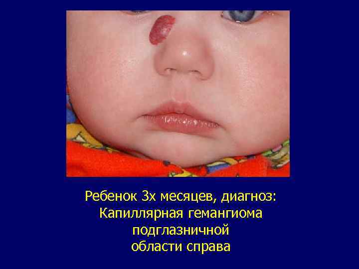 Ребенок 3 х месяцев, диагноз: Капиллярная гемангиома подглазничной области справа 