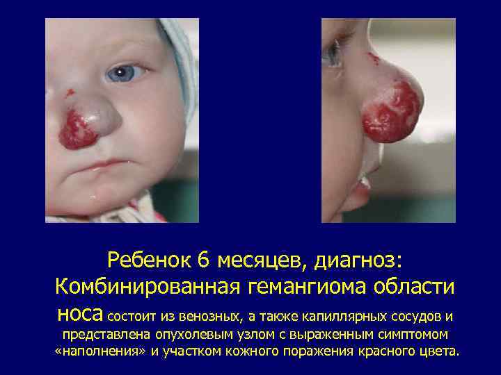 Ребенок 6 месяцев, диагноз: Комбинированная гемангиома области носа состоит из венозных, а также капиллярных