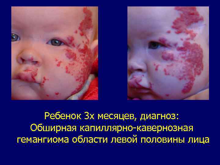 Ребенок 3 х месяцев, диагноз: Обширная капиллярно-кавернозная гемангиома области левой половины лица 