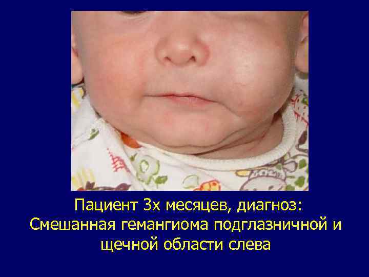 Пациент 3 х месяцев, диагноз: Смешанная гемангиома подглазничной и щечной области слева 