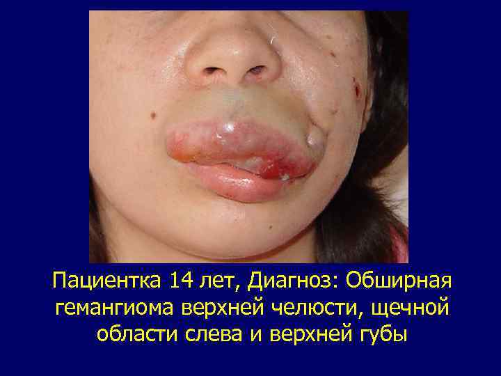Пациентка 14 лет, Диагноз: Обширная гемангиома верхней челюсти, щечной области слева и верхней губы