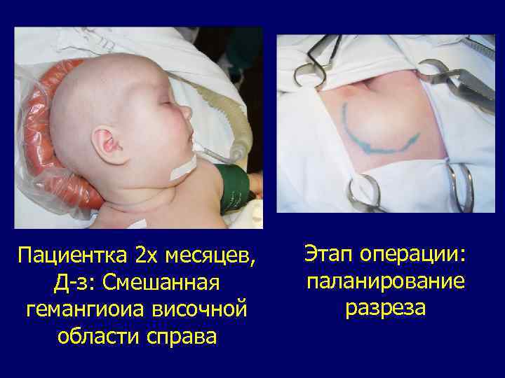 Пациентка 2 х месяцев, Д-з: Смешанная гемангиоиа височной области справа Этап операции: паланирование разреза