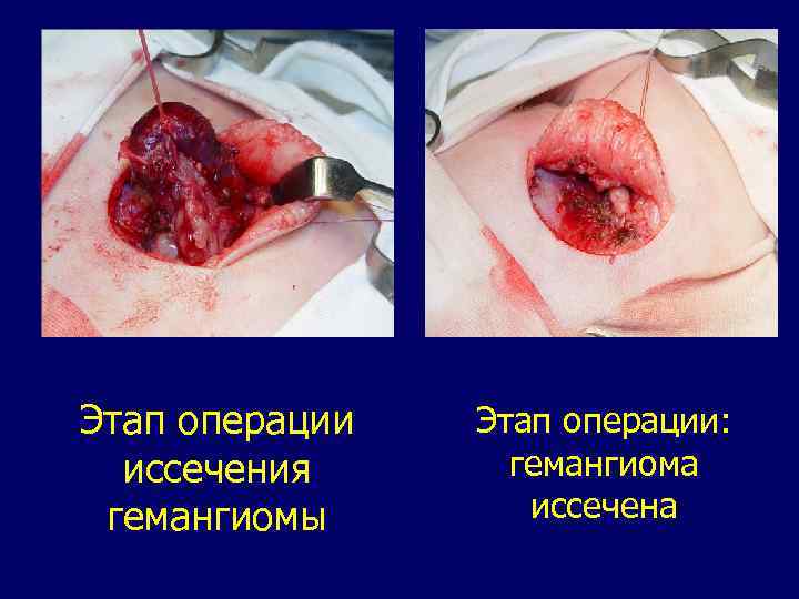 Этап операции иссечения гемангиомы Этап операции: гемангиома иссечена 