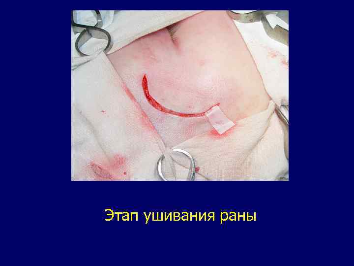 Этап ушивания раны 