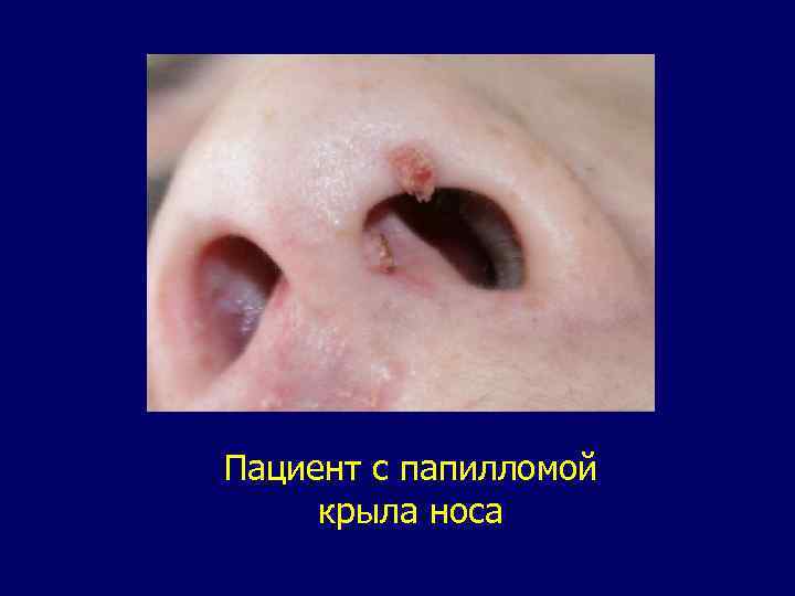 Пациент c папилломой крыла носа 