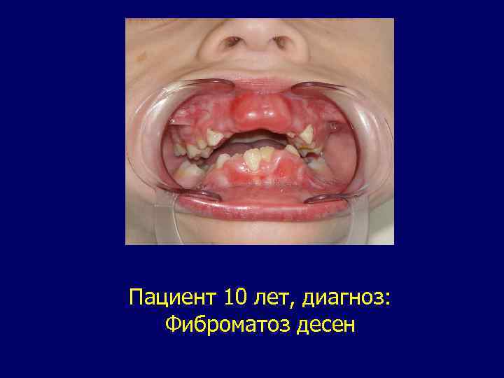 Пациент 10 лет, диагноз: Фиброматоз десен 