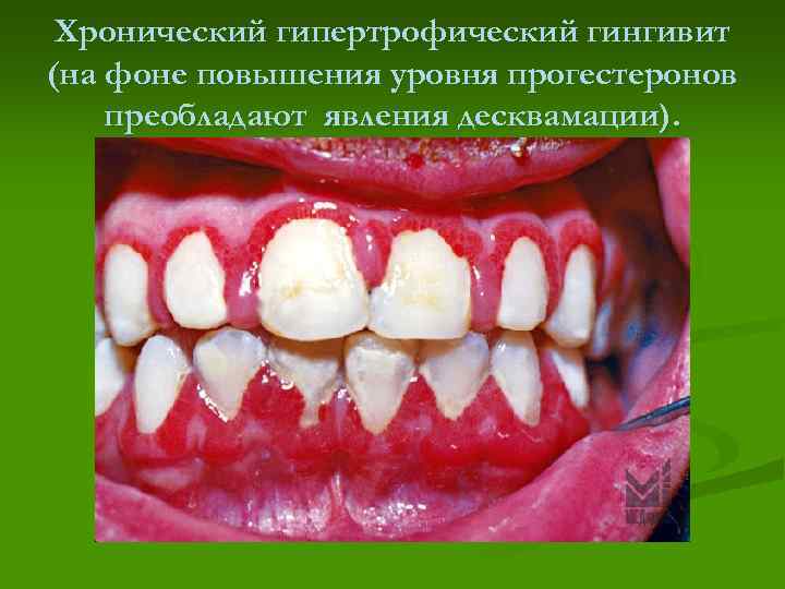 Хронический гипертрофический гингивит (на фоне повышения уровня прогестеронов преобладают явления десквамации). 