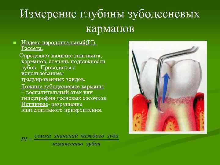 Измерение глубины зубодесневых карманов n Индекс пародонтальный(PI), Рассела. Определяет наличие гингивита, карманов, степень подвижности
