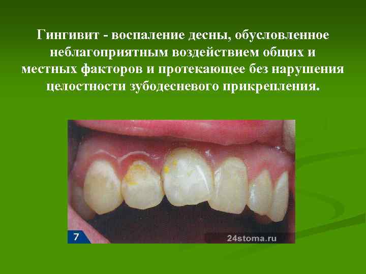 Гингивит - воспаление десны, обусловленное неблагоприятным воздействием общих и местных факторов и протекающее без