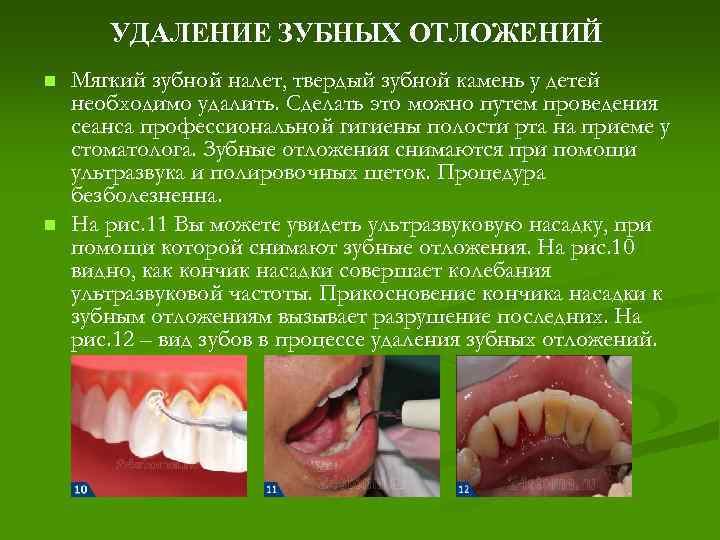 Зубные отложения презентация